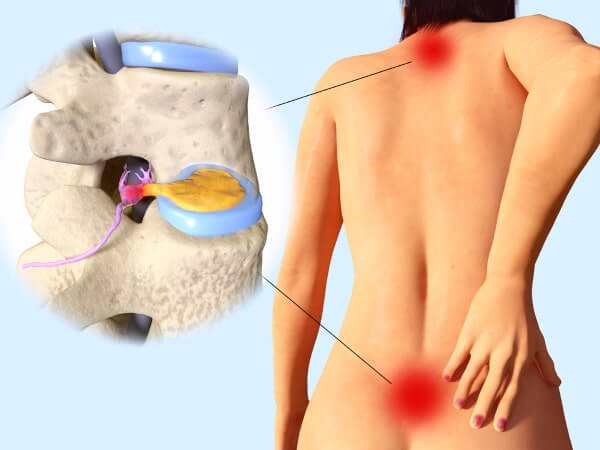 Bandscheibenvorfall - stechende Dauerschmerzen im Rückenbereich